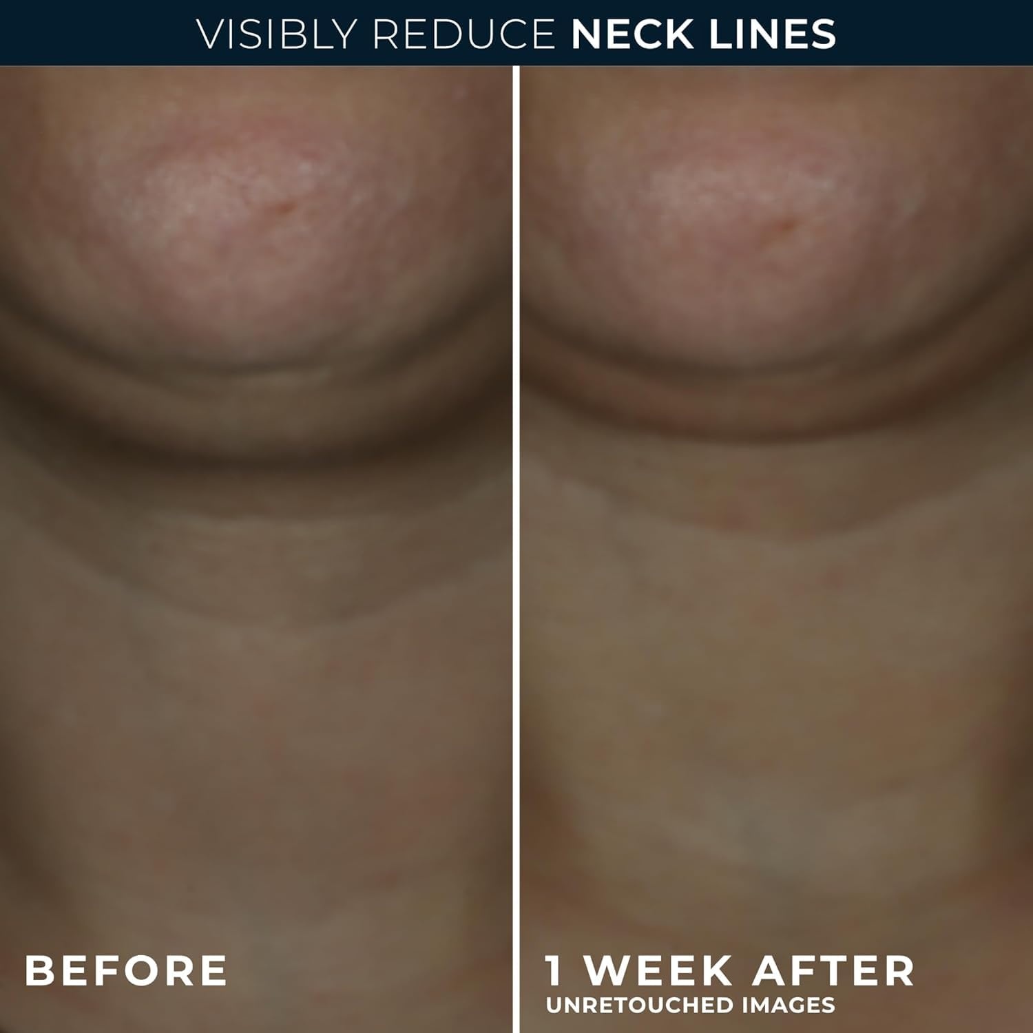 image:imageRoC Derm Correxion Neck Cream with Hyaluronic Acid Advanced Retinol to visibly Tighten amp Lift Horizontal Neck Lines Facial Moisturizer to Contour Face 17 oz with RoC Retinol Eye Packette
