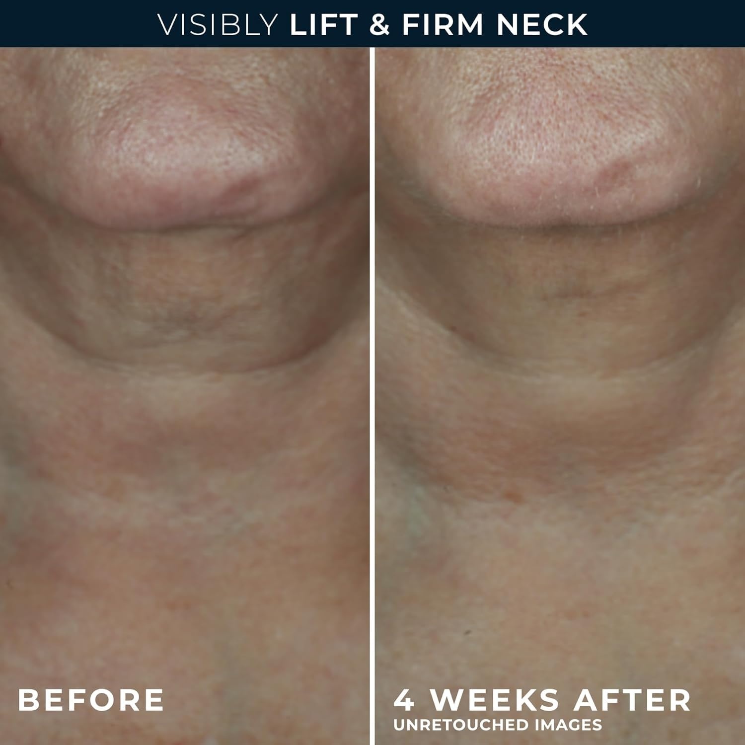 image:imageRoC Derm Correxion Neck Cream with Hyaluronic Acid Advanced Retinol to visibly Tighten amp Lift Horizontal Neck Lines Facial Moisturizer to Contour Face 17 oz with RoC Retinol Eye Packette