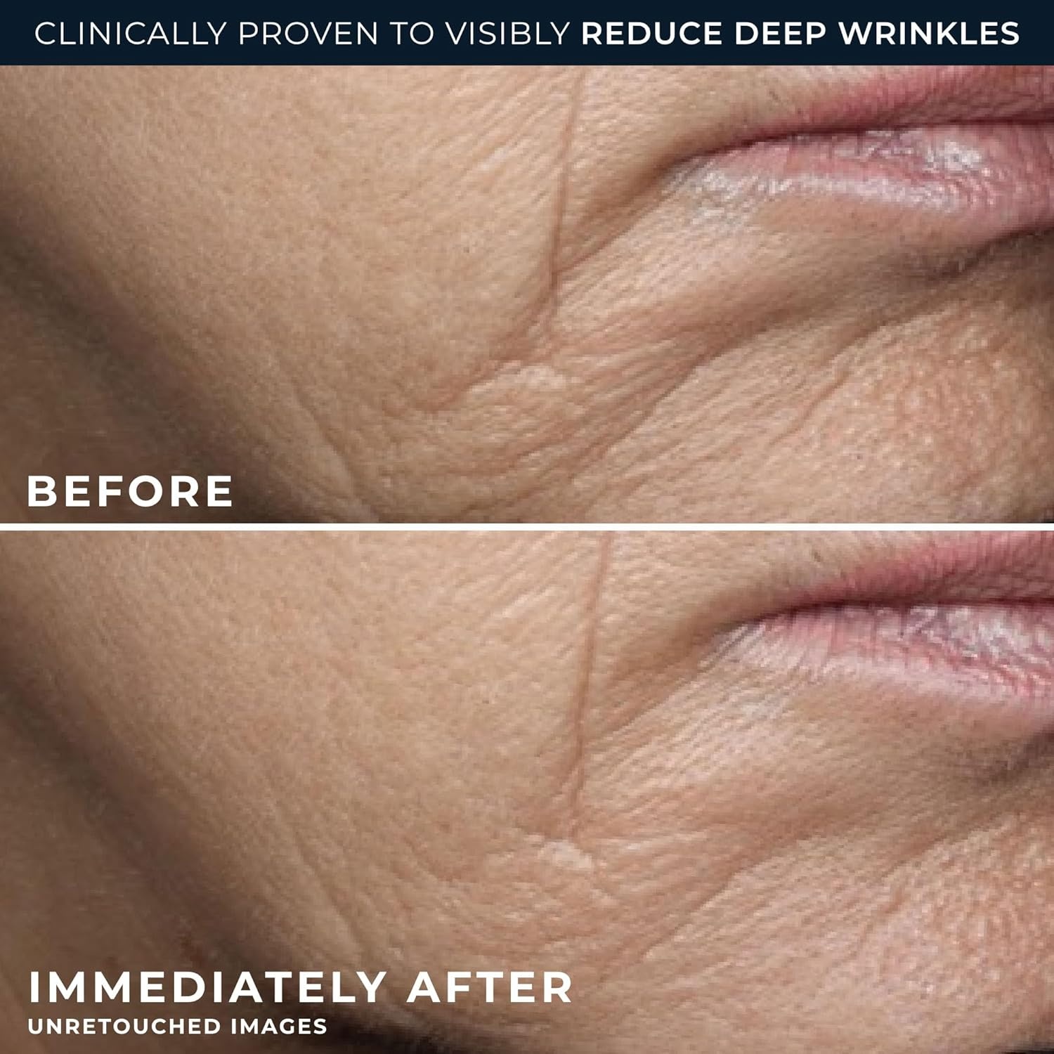 image:imageRoC Retinol Correxion Deep Wrinkle Daily Face Moisturizer with Sunscreen SPF 30 for Fine Lines Dark Spots PostAcne Scars 1 Ounce Packaging May VaryDeep Wrinkle Rich Cream