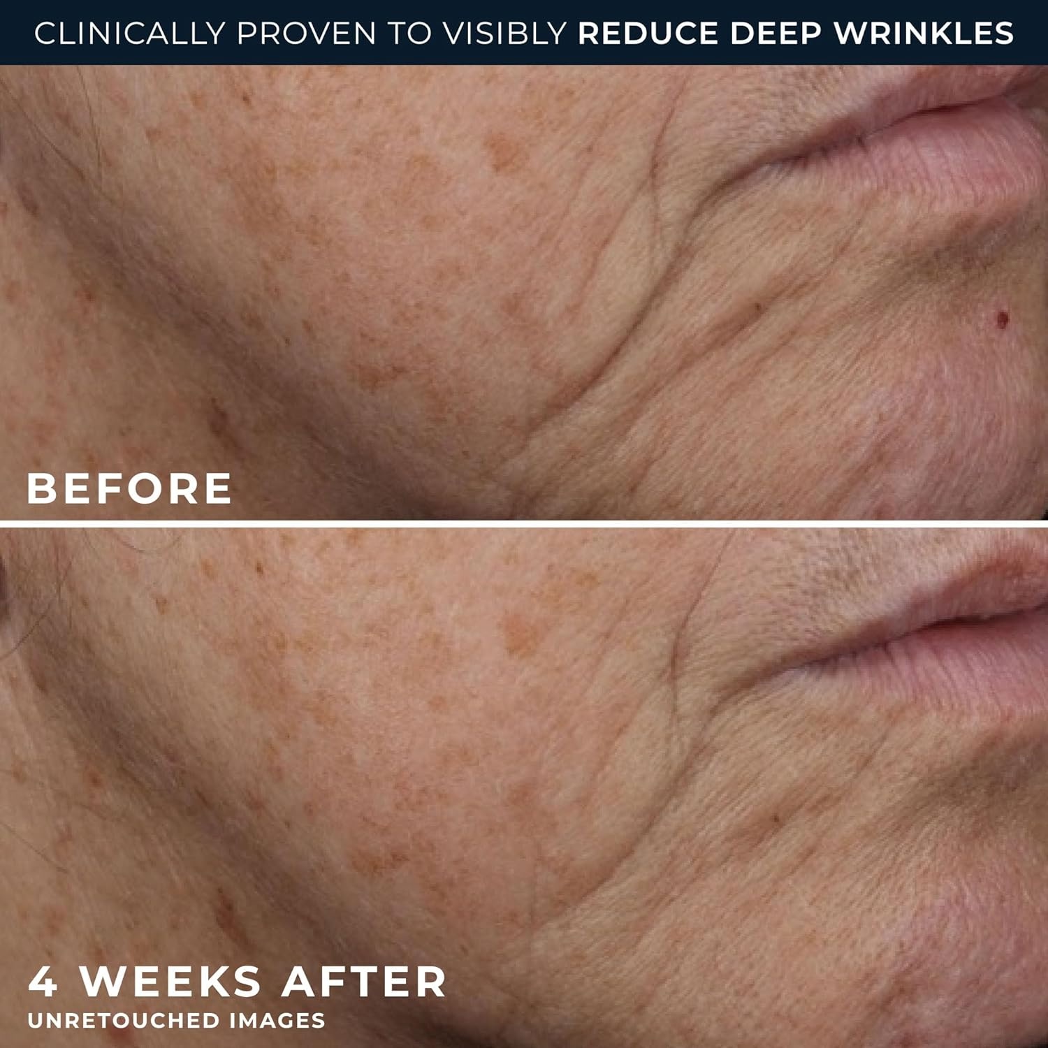 image:imageRoC Retinol Correxion Deep Wrinkle Daily Face Moisturizer with Sunscreen SPF 30 for Fine Lines Dark Spots PostAcne Scars 1 Ounce Packaging May VaryDeep Wrinkle Rich Cream